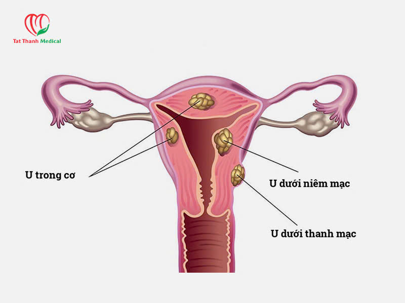 Tổng quan về u xơ tử cung và phương pháp điều trị đột phá hiện nay